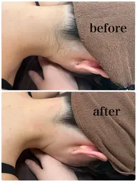 うなじ脱毛♡うなじ美人へ✨🩷