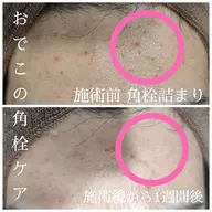 シミそばかす/ニキビ/ニキビ跡に！光フォト