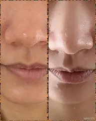 顔脱毛＋角栓除去（ダニ取り）＋毛穴掃除！徹底的にお掃除しましょう！メンズのお客様が増えてます！