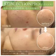 韓国エステ式ポテンツァ💉🇰🇷スキンジェクション（アクニット💚）初のフィラートリートメント/ニキビケアにはこれ❣️