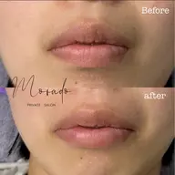 部分WAX1ヶ所(おでこ/頬/口周り/鼻毛/フェイスライン下)