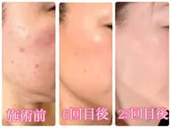 肌質改善VOSイノスピキュール15万本