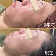 フェイシャルエステ