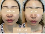 【韓国肌管理】無添加天然ハーブピーリング/剥離なし/肌艶UP/肌トラブル改善