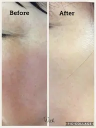 リベルハーブピーリング（お肌の生まれ変わり）剥離するピーリングです💕他社のピーリング剤より5​〜​6倍多い棘配合😎即効果