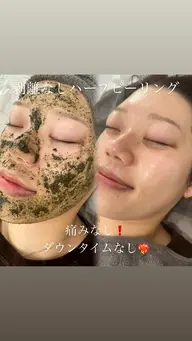 明日🈳有り♡【初回限定価格 】50％OFF‼️剥離なしハーブピーリング🌿ニキビ・毛穴悩みを根本改善🎀