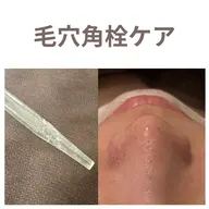 🫧毛穴クリアフェイシャル🫧角栓の詰まり・黒ずみ・ザラつきに(施術時間約45分)