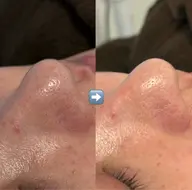 ハイドラフェイシャル(毛穴洗浄)