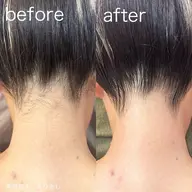 【学割U24✨】うなじ＋背中上光脱毛【ミニモ学割】