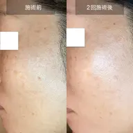 【シミ改善集中ケア】 これ以上作らせない対策も❣️シミケア20分集中✨まぶた・肝斑・ニキビ跡にも可能♪