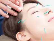 リピーター　美容鍼