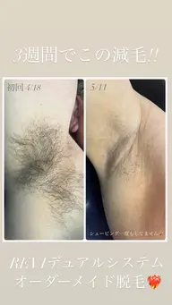 メンズ全身脱毛【お試し⭐️】脱毛を始めたい方におすすめ🙌🏻シェービング付き