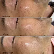 ダウンタイムなし!美容初心者の方にも🔰マンデル酸入ピーリング💊ターンオーバーを促進✨ニキビ、シミ、しわ、くすみに◎✨