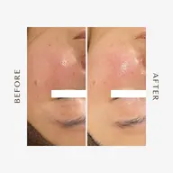 【肌再生コース】毛穴を引き締め、内側からハリとツヤを高めます✨