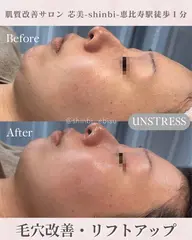 新生活応援🌸毛穴洗浄プレゼント！肌別ピーリング×小顔LDM通常¥19,800