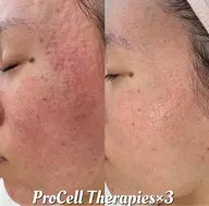 プロセルセラピーズ・フェイシャル