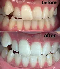 ホームホワイトニング来店付セット