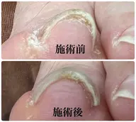 フット親指巻き爪矯正練習＋ジェルワンカラー⚠️必ず以下の補足説明をご確認ください⚠️