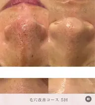 ＼はじめてのメンズ美容👨🌱／男性の気になる毛穴や肌質改善へ徹底アプローチ🫧毛穴洗浄×韓国式ピーリング🇰🇷