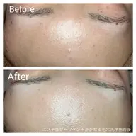 🔸上級者向け🔸艶肌・潤い・毛穴の開き・加齢によるハリ弾力・シミシワケアに💎エステ版ダーマフェイシャル90分💎