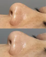 👶🏻【ツルツル毛穴洗浄コース】👶🏻詰まり・黒ずみゼロへ!毛穴すっきり、透明感あふれる素肌へ🫧👃✨