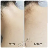 VIO&脇orうなじシュガーリング🍋脱毛