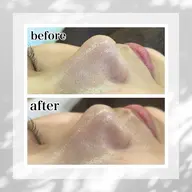 【1日1名限定】毛穴洗浄お試しTゾーン