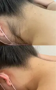 ミニモ限定💓レディース全身脱毛✨うなじ、VIO、お顔あり