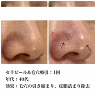 毛穴ケア+ご褒美マスク&ヘッドマッサージ付き💆 ¥12,000→