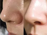 【毛穴洗浄】脱いちご鼻!皮脂/角栓/黒ずみ/ざらざら/ごわつき/テカリ改善!毛穴洗浄でツルツル肌!《ミニモ限定》