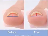 巻き爪ケア１本3300円