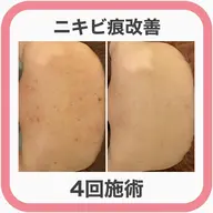 平日限定価格❣️ハーブピーリングより優しい低刺激ピーリング&温熱イオンロウパック🍯お背中の肌荒れ集中ケア🧚✨