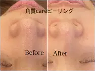 アイリッドアップパーマ&角質ケアピーリング