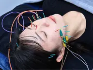 人気No.1✨【たるみ解消/むくみ/美肌/リフトアップ/小顔効果/エラ張り軽減】小顔矯正＋リフトUP美容鍼 60分