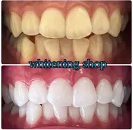 平日限定☆セルフホワイトニング20分×2回照射！10名様限定→残り7名様