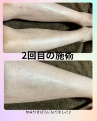 ◆メンズ◆ひざ下つるつるモテ肌(ひざ上なども選択可)