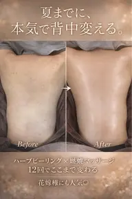 当日限定価格❤️‍🔥70%オフ背中ハーブピーリング×幹細胞パック付🌿魅せる背中へ