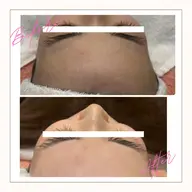 【1番人気✩】🐝⋆゜シュガーリング 顔シュガーリング脱毛