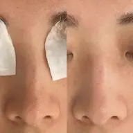 【黒ずみ/詰まり/開き毛穴】毛穴診断付き🔍毛穴洗浄コース