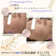 光フェイシャル×水素リセットケア 　～くすみ・紫外線ダメージが気になる方へ～