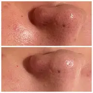 【❤️3.4月限定特別なイベント前に❤️】ツヤ肌を作る✨毛穴洗浄ケア＋生コラーゲン導入＋細胞活性化セルサー