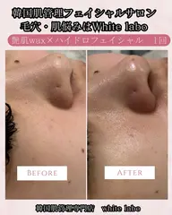 ツルツルたまご肌が叶う🥚✨【毛穴洗浄◆ハイドロフェイシャル✕艶肌フェイスワックス】鎮静パック付🫧