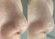 【 徹底毛穴洗浄 】皮脂・ベタつきすっきりオフ ¥6,600