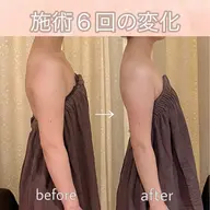 【ブライダルの方限定💐】二の腕、背中メニュー