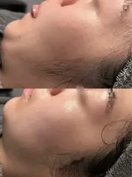 ハーブピーリング🌿オプション3つ🎁10.000円OFF