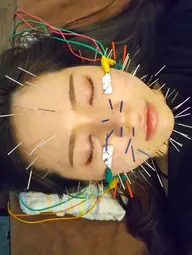 ミニモ限定!春限定!あなたの肌の悩みを解決します!美容鍼を体験しよう