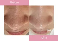 ✨\オープン記念/✨人気ナンバーワン！【毛穴＋美容液導入コース】