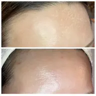 同窓会、成人式、結婚式etc…翌日のお化粧ノリばっちり👍お鼻つるつる、むくみ撃退、つや肌仕上げ/痛み・ダウンタイムなし