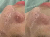 【毛穴洗浄💧】毛穴の汚れごっそり洗浄🪄🫧