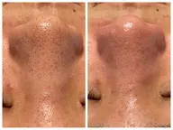 【毛穴大洗浄！！】ハイドラフェイシャル